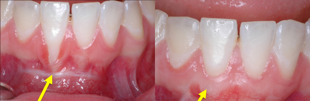 before recession gum pull frenum treatment lanap tissue connective orthodontic 7mm