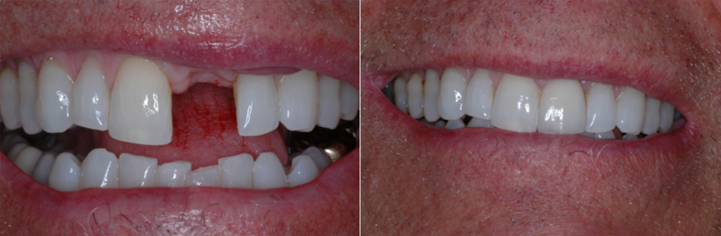 Before and After Dental Implants in Newport Beach, CA