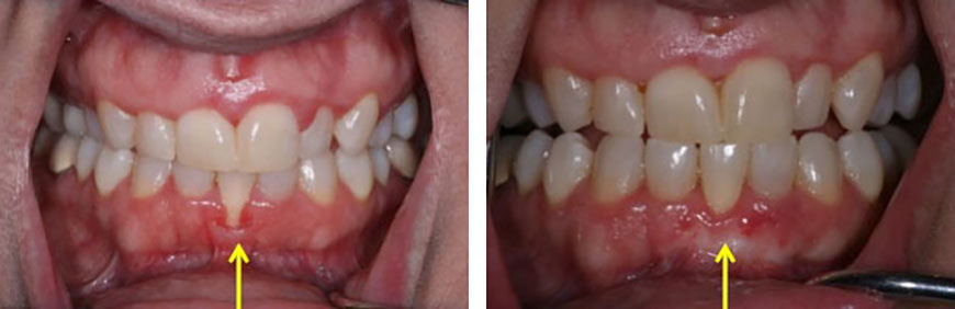 pain-in-gums-lower-front-teeth-teethwalls