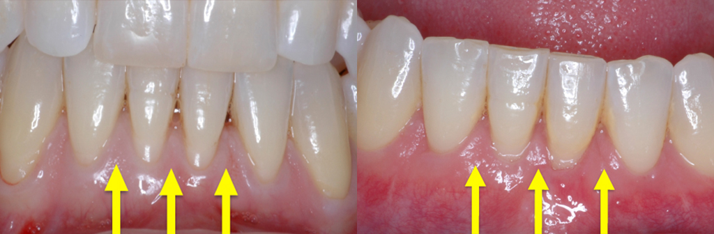 Before and After Papilla Reconstruction in Newport Beach, CA