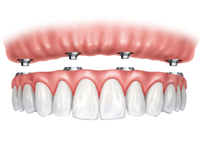 Ball Retained Dentures